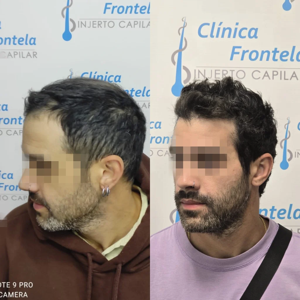 injerto capilar en Estepona