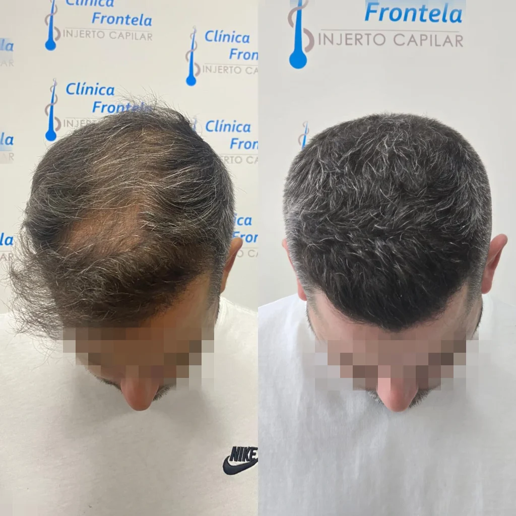 injerto capilar en Málaga