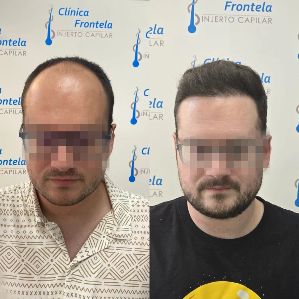 injerto capilar en Madrid