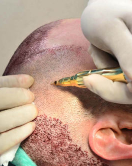 trasplante capilar FUE vs FUE GOLD