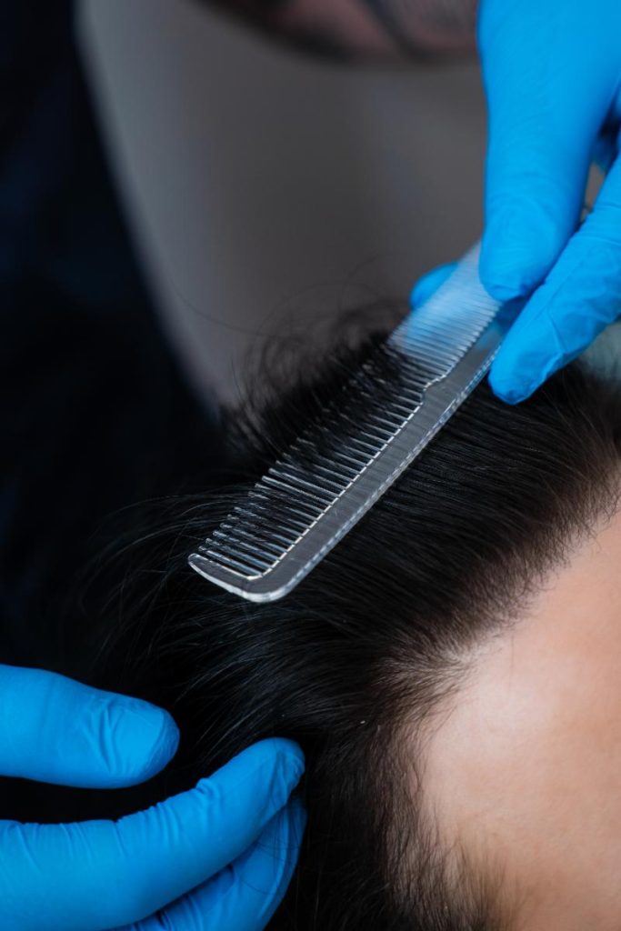 implantes capilares mejor valorados