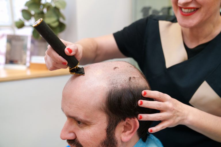 injertos de pelo mal hechos