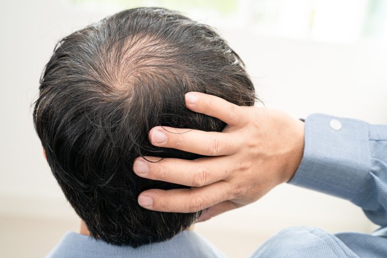 Hombre de espaldas tocándose la coronilla con poca densidad, pensando en un injerto capilar en Guadiaro
